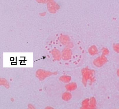  [울산 비뇨기과] 성병 임질 요도염 검사 PCR의 정확성