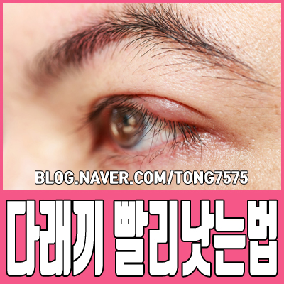  다래끼 빨리낫는법 원인부터 제대로 알아보기