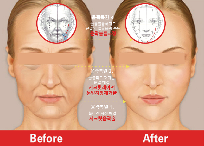 안면거상이 좋다