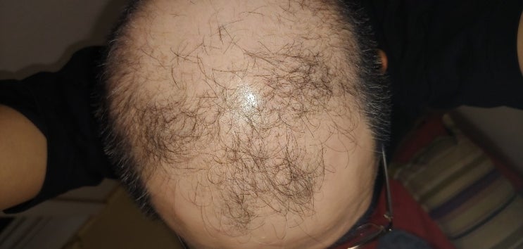  탈모치료 두타스테리드연질캡슐0.5mg(아보타드)을 병원처방으로 의료보험혜택 받아서 90일 사용한 탈모치료 후기입니다.실비보험청구가능