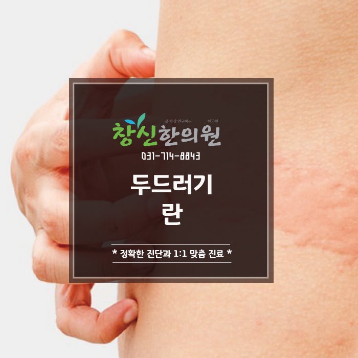 유아 두드러기의 원인과 효과적인 한방치료 2