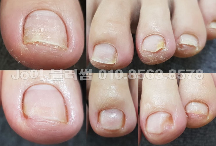  용인에서 문제성발톱 관리받고 예뻐지자. 발톱이상하면 고민없이 조이블러썸!!!