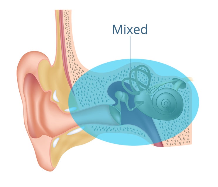  혼합성 난청(Mixed Hearing Loss / Combined Hearing Loss)