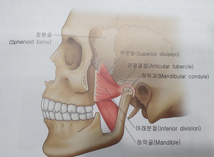  외측익상근통증