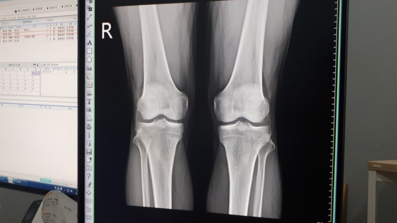 연수동정형외과에서 근골격계 질환의 효과적인 치료