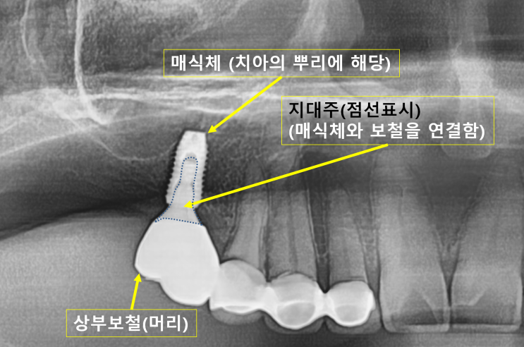 천안임플란트 | 구강외과교수의 임플란트 이야기 | 임플란트 수술과 뼈이식  [요약정리편] :-)