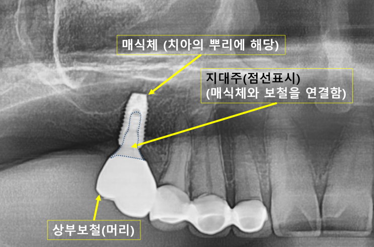 천안임플란트 | 구강외과교수의 임플란트 이야기 | 임플란트 수술과 뼈이식  [요약정리편] :-)