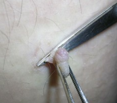  [울산 비뇨기과] 남성 곤지름 검사 및 HPV 검사