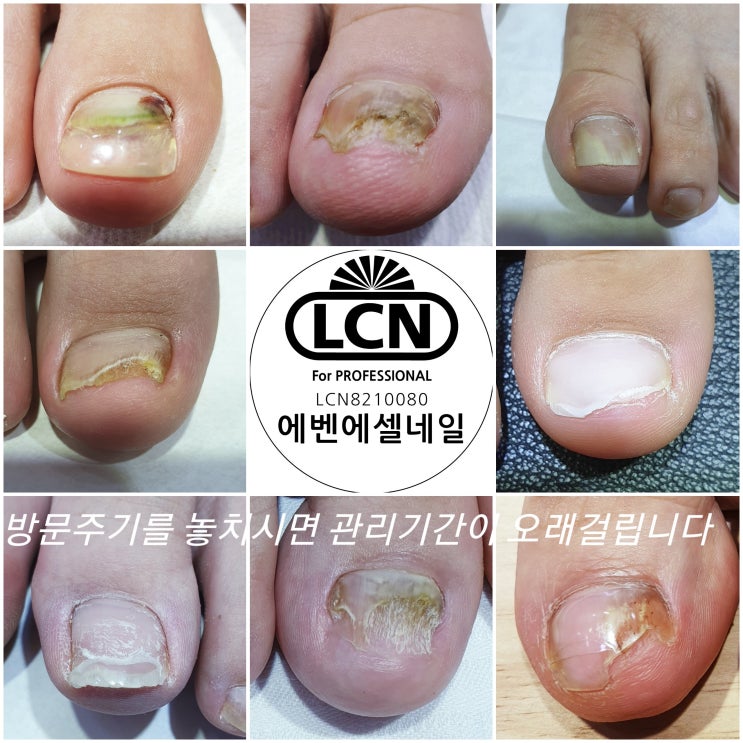  안산 문제성발톱 LCN발톱관리 인증네일샵 에벤에셀 네일 & 스파