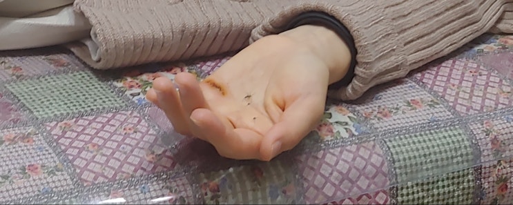  손바닥 결절종 수술.. 그 이후, (2번째 이야기)