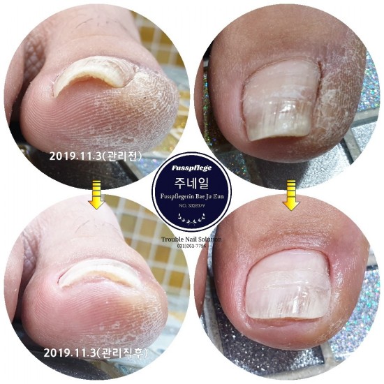 발톱이 아파 걸을수가 없어요./분당용인수원수지보정동백죽전동/주네일/무좀파고드는내향성발톱손톱변형전문네일샵 발톱이 아파 걸을수가 없어요./분당용인수원수지보정동백죽전동/주네일/무좀파고드는내향성발톱손톱변형전문네일샵