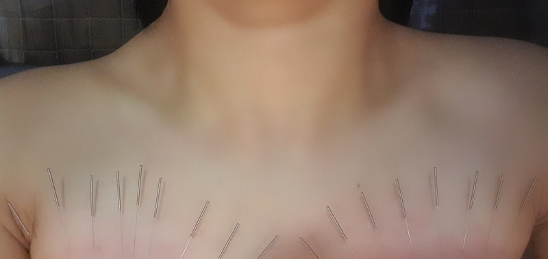가슴매선침 화유침  4회차 솔직후기_기록2