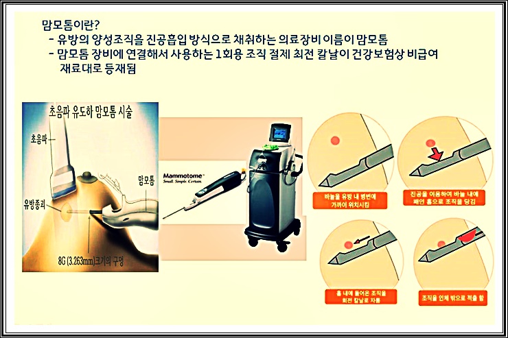 맘모톱 맘모톰 맘모툼 유방검사