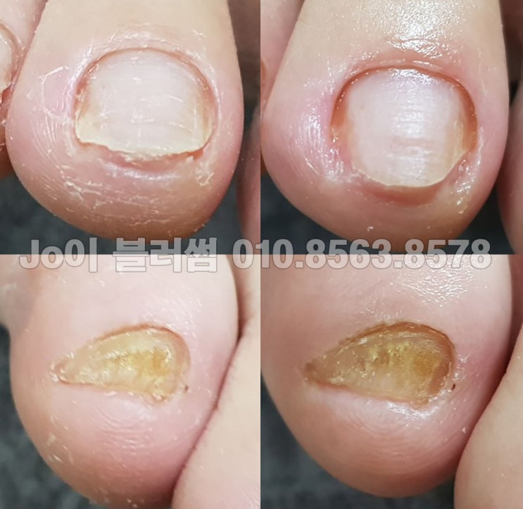  용인 발톱교정, 손톱교정, 파고드는발톱, 문제성발톱 관리 네일샵