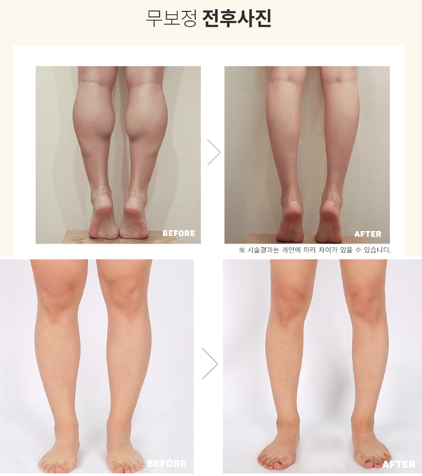 셀룰라이트 마사지기로 종아리 알 제거