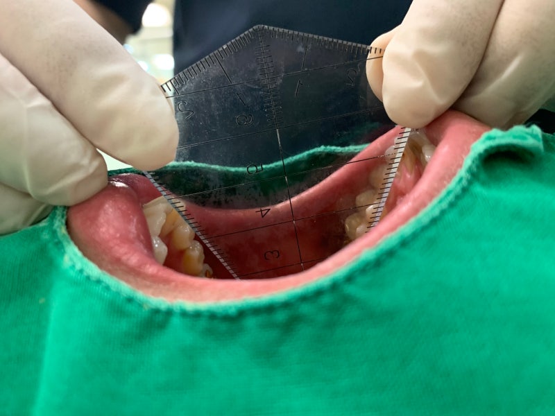 왼쪽 귀 밑에가 아픈 이유