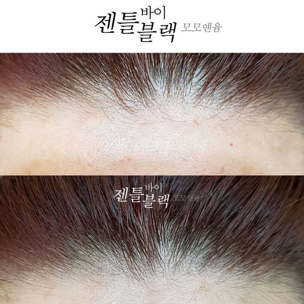  [젠틀바이블랙-헤어라인교정] 이마가 이렇게 이뻤나??? 자신있게 헤어 업스타일 도전!!