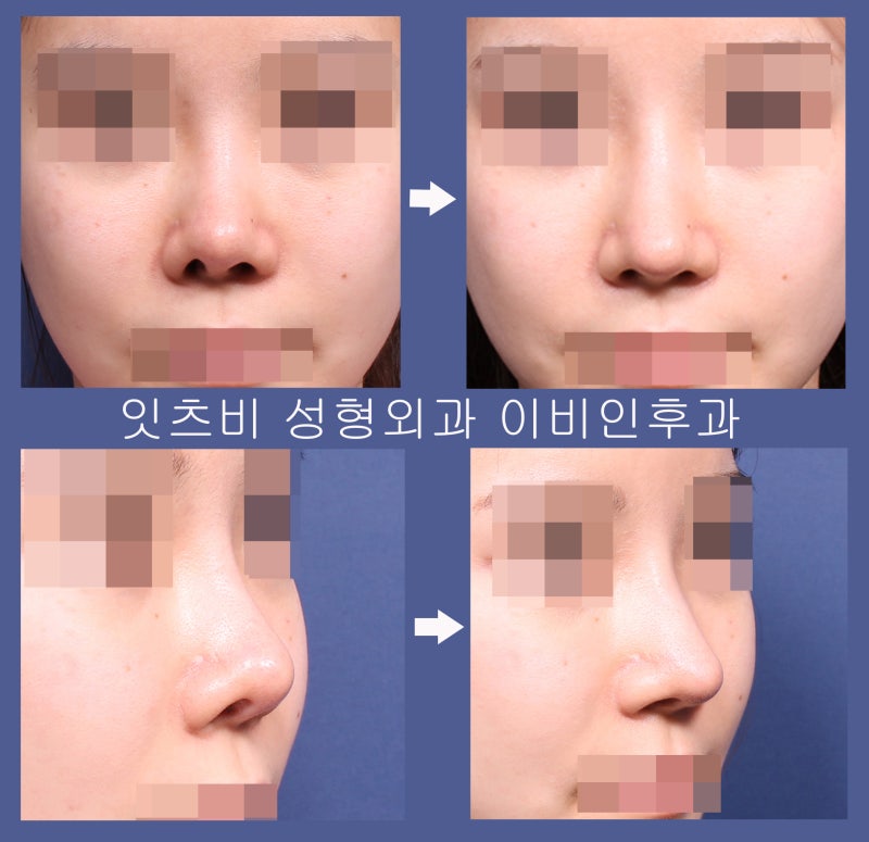구축코 재수술 네번째 (비개방코성형, 들창코 들린코내리기) 6