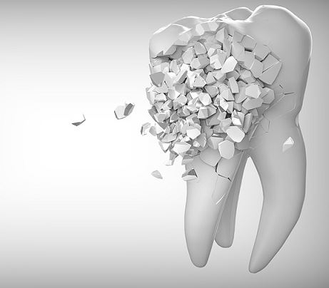 치과에서 임플란트 치료 기간을 줄일 수 있는 방법은?