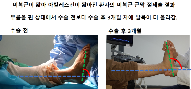짧은 아킬레스건으로 인한 종아리 당김 증상 : 10분만 걸어도 종아리 바깥쪽이 당겨집니다! : 아킬레스건 연장수술 (족부성형외과 전문의 김지범)