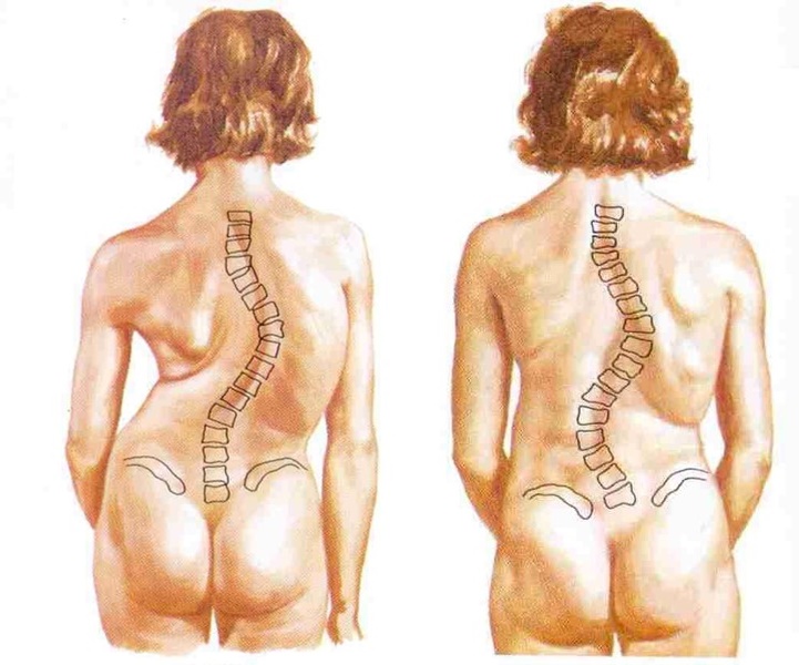 척추측만증(Scoliosis)과 척추변형 그교정방법
