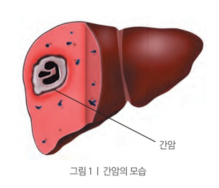 간암검사방법과 병기는? : 네이버 블로그