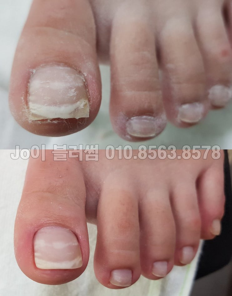  용인 발톱 눌림 변형이 생긴 발톱이상증상 관리하는 네일샵 조이블러썸
