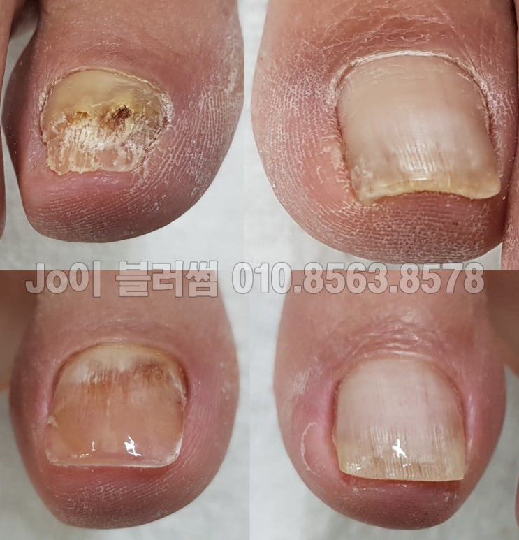  용인 발톱, 각질, 발톱이 갈라지고 상해서 부서지면서 가루가 떨어지는 상태의 발톱 관리 네일샵 조이블러썸