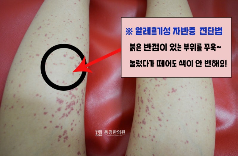 인천알레르기 자반 한약 붉은 반점 원인을 알아보자 4