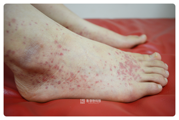 인천알레르기 자반 한약 붉은 반점 원인을 알아보자 5