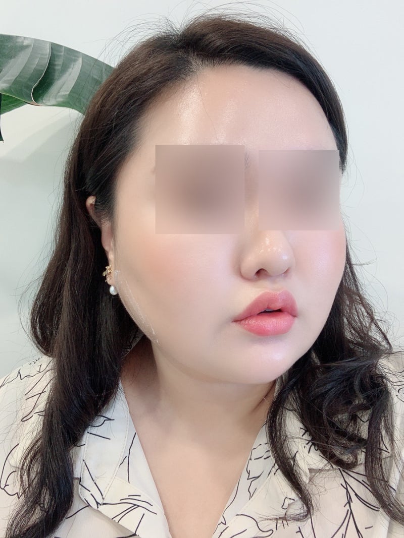 신논현피부과 입꼬리보톡스 추천 4