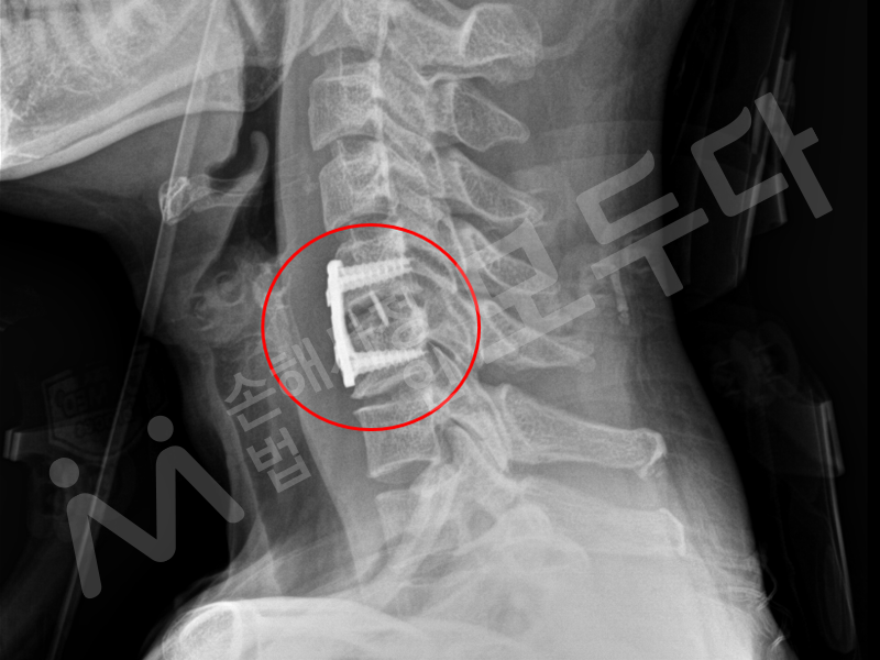 교통사고 손해사정인-교통사고 경추골절보상 무료상담 4