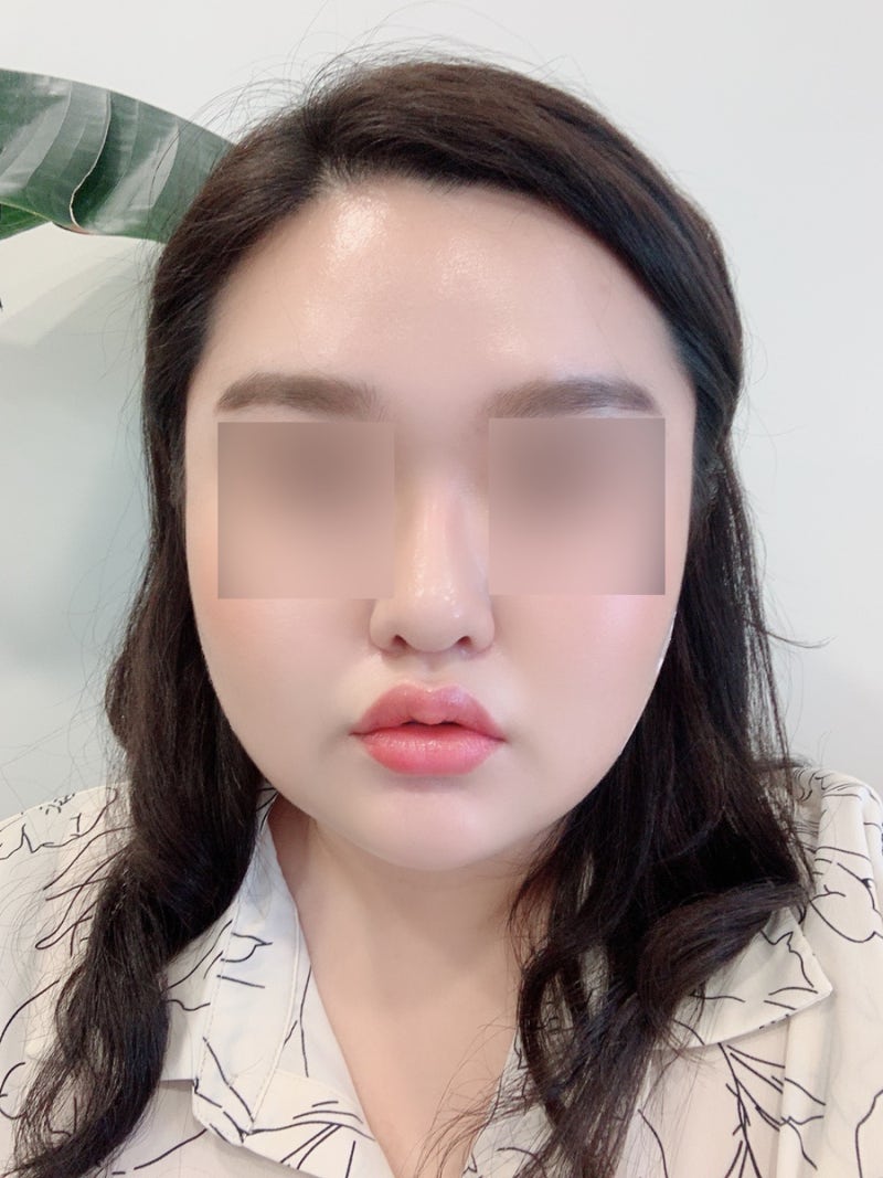 신논현피부과 입꼬리보톡스 추천