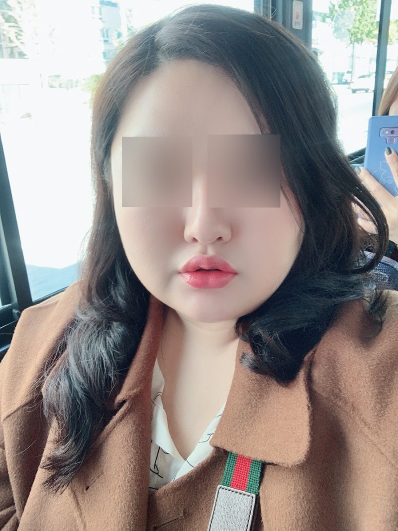 신논현피부과 입꼬리보톡스 추천 5