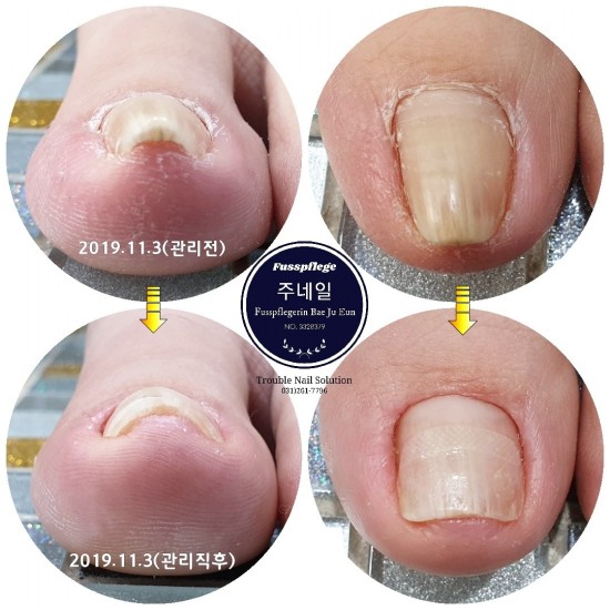 멀리 울산에서 3년만에 파고드는발톱 통증 때문에../분당용인수원수지보정동백죽전동/주네일/무좀파고드는내향성발톱손톱변형전문네일샵 멀리 울산에서 3년만에 파고드는발톱 통증 때문에../분당용인수원수지보정동백죽전동/주네일/무좀파고드는내향성발톱손톱변형전문네일샵