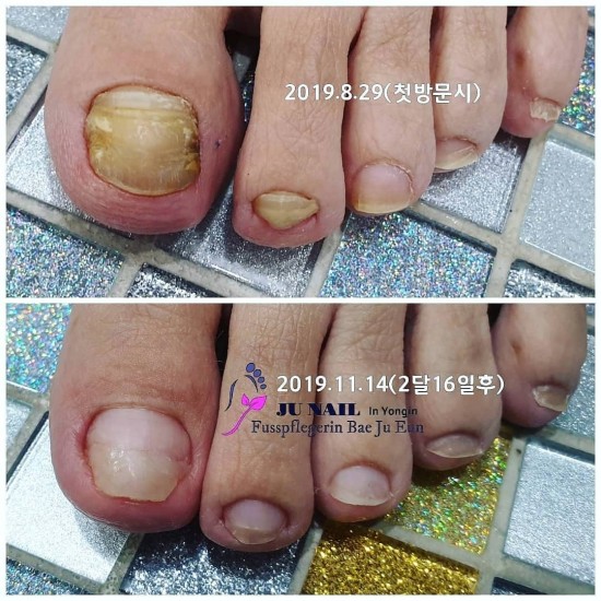 발톱무좀관리 2달보름후. 성장이 멈추었던발톱이 자라기 시작했어요./분당용인수원수지보정동백죽전동/주네일/무좀파고드는내향성발톱손톱변형전문네일샵 발톱무좀관리 2달보름후. 성장이 멈추었던발톱이 자라기 시작했어요./분당용인수원수지보정동백죽전동/주네일/무좀파고드는내향성발톱손톱변형전문네일샵