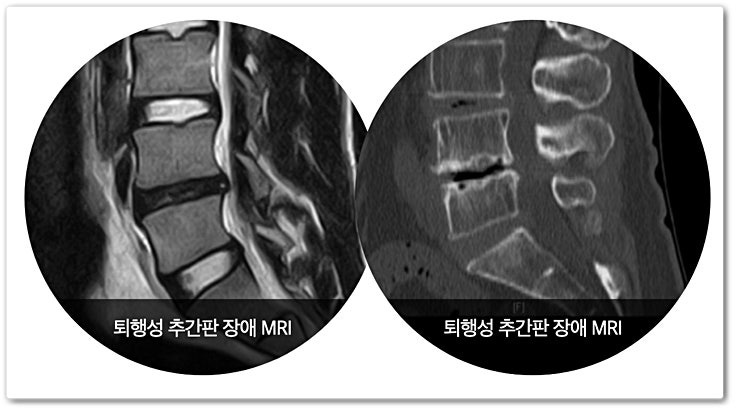 왼팔 뒤쪽과 손등이 아픈 제6-7 경추 디스크 (양방향 내시경 수술)