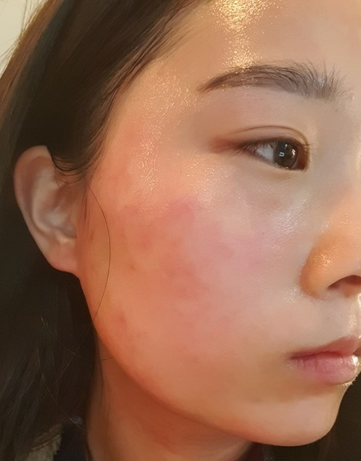  서울 신림 피부관리실: 하라네이처 민감성 피부 트러블 고주파 관리