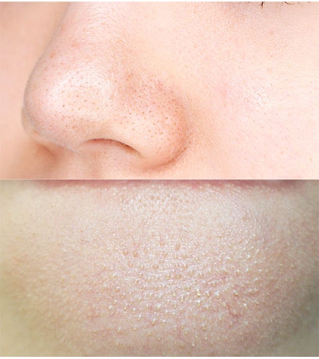 화이트헤드 제거를 편하게 실천한다! 2