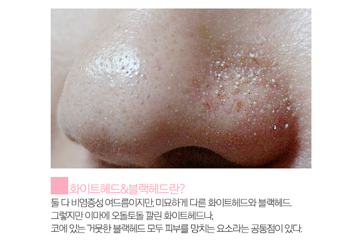 화이트헤드 제거를 편하게 실천한다! 1