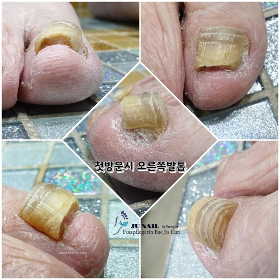 할머니의 너무도 두껍고 딱딱해진 처음보는 발톱무좀/분당용인수원수지보정동백죽전동/주네일/무좀파고드는내향성발톱손톱변형전문네일샵 할머니의 너무도 두껍고 딱딱해진 처음보는 발톱무좀/분당용인수원수지보정동백죽전동/주네일/무좀파고드는내향성발톱손톱변형전문네일샵