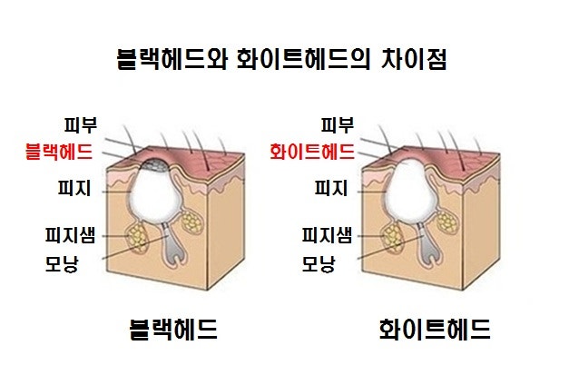 화이트헤드 제거를 편하게 실천한다! 4