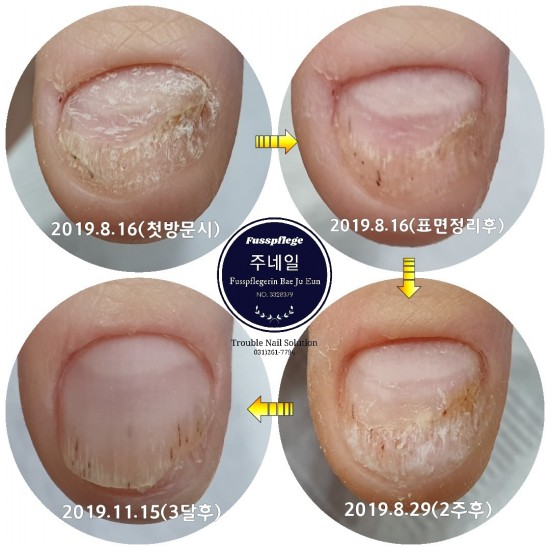 손톱무좀건선문제성손톱/분당용인수원수지보정동백죽전동/주네일/무좀파고드는내향성발톱손톱변형전문네일샵