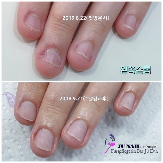 물어뜯는손톱 1달 관리후기/분당용인수원수지보정동백죽전동/주네일/무좀파고드는내향성발톱손톱변형전문네일샵 물어뜯는손톱 1달 관리후기/분당용인수원수지보정동백죽전동/주네일/무좀파고드는내향성발톱손톱변형전문네일샵