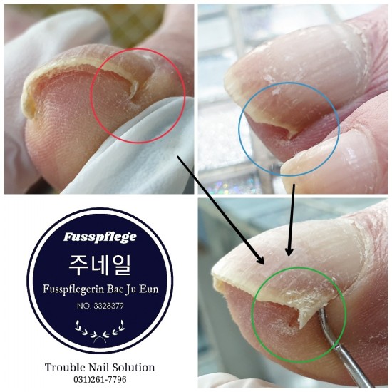발톱이파고들어 보행조차 힘들었던 80대중반의 할아버지 발톱관리후기/분당용인수원수지보정동백죽전동/주네일/무좀파고드는내향성발톱손톱변형전문네일샵 발톱이파고들어 보행조차 힘들었던 80대중반의 할아버지 발톱관리후기/분당용인수원수지보정동백죽전동/주네일/무좀파고드는내향성발톱손톱변형전문네일샵