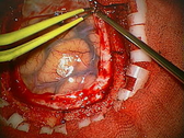  Craniotomy