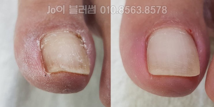  용인 발톱에 관련된 모든 관리가 가능한 발톱 관리 전문 네일샵, 발톱이라면 자신 있는 관리 조이블러썸