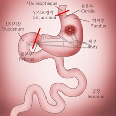  Total gastrectomy