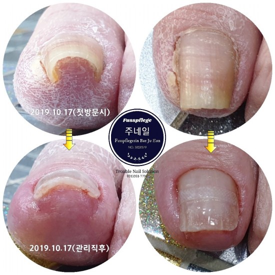 병원수술없이 내성발톱때문에 고통받는 할머니의 관리후기/분당용인수원수지보정동백죽전동/주네일/무좀파고드는내향성발톱손톱변형전문네일샵