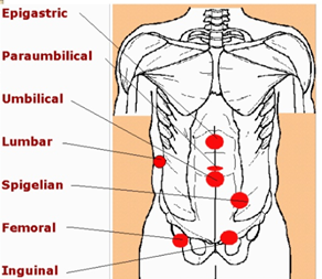  Herniorrhapy(=hernioplasty)